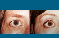 before and after eyelid surgery right eye view female patient case 2479