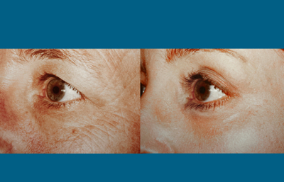 before and after eyelid surgery left angle eye view female patient case 2479