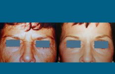 before and after eyelid surgery female patient front view case 2487