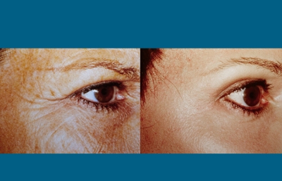 before and after eyelid surgery female patient right angle view case 2487