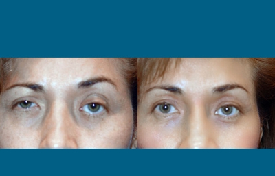 before and after eyelid surgery female patient front view case 2490