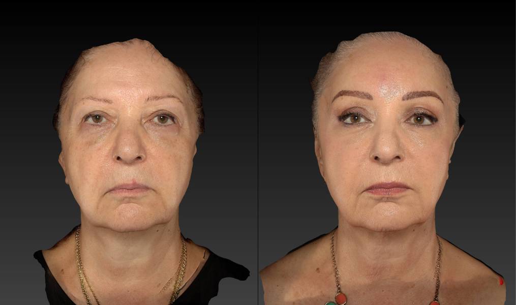 before and after eyelid surgery female patient front view case 3112