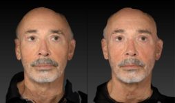 before and after eyelid surgery male patient front view case 3132