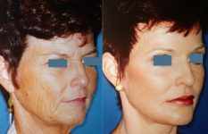 before and after eyelid surgery right angle view case 2487