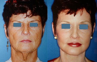 before and after eyelid surgery front view case 2487