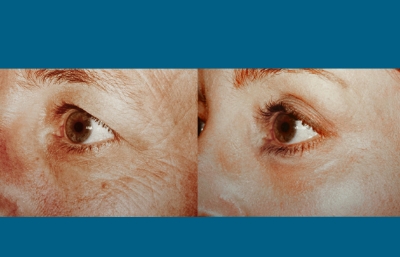 before and after facelift | mid-facelift left angle closeup view case 2028