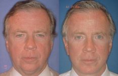 before and after facelift | mid-facelift male patient front view case 2035