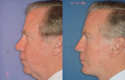 before and after facelift | mid-facelift male patient left side view case 2035