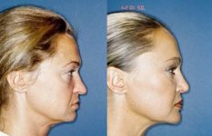 before and after facelift | mid-facelift female patient right side view case 2040