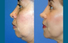 before and after facelift | mid-facelift female patient left side view case 2048