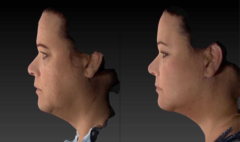 before and after facelift | mid-facelift female patient left side view case 3093