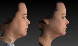 before and after facelift | mid-facelift female patient right side view case 3093