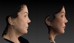before and after facelift | mid-facelift right side view case 2906