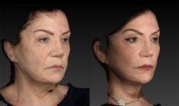 before and after facelift | mid-facelift right angle view case 2906