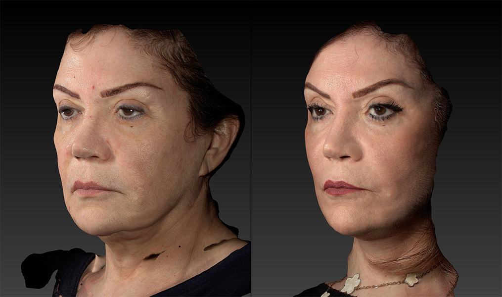 before and after facelift | mid-facelift left angle view case 2906