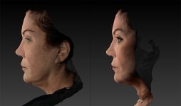before and after facelift | mid-facelift left side view case 2906