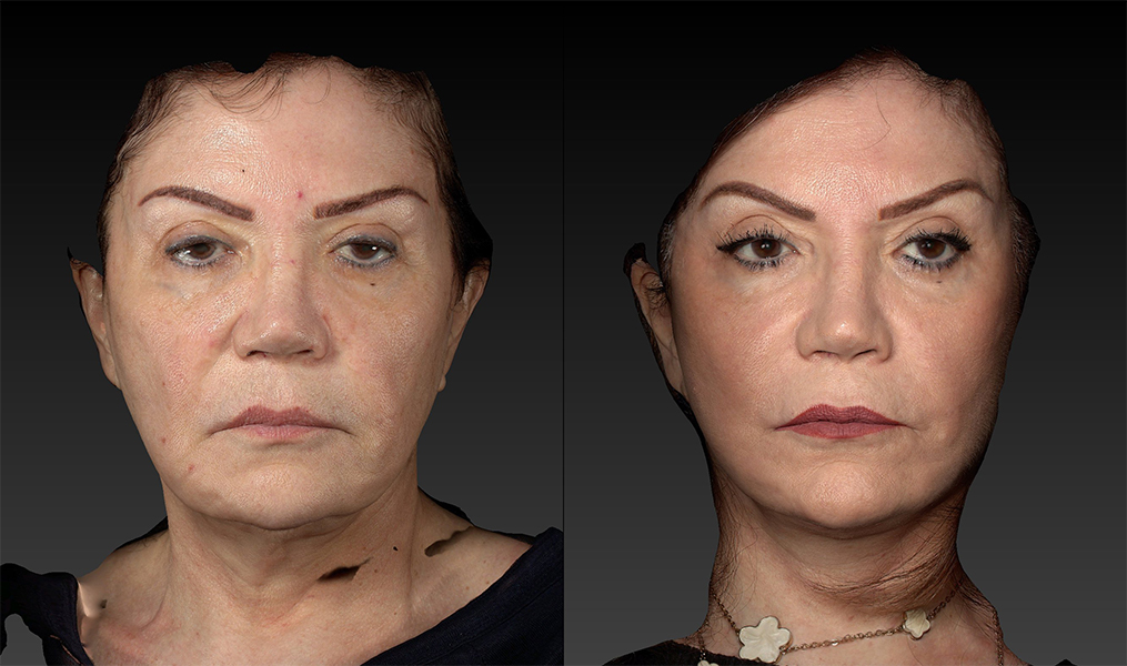 before and after facelift | mid-facelift front view case 2906