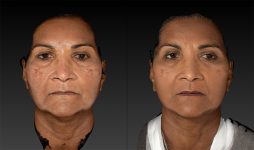 before and after facelift | mid-facelift front view case 3046