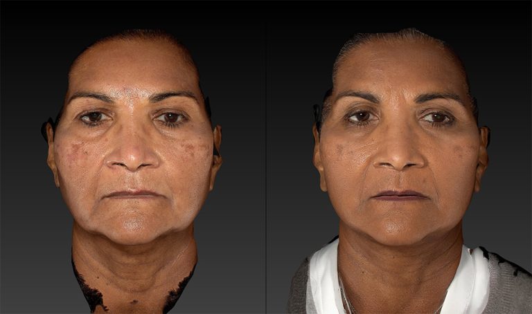 before and after facelift | mid-facelift front view case 3046