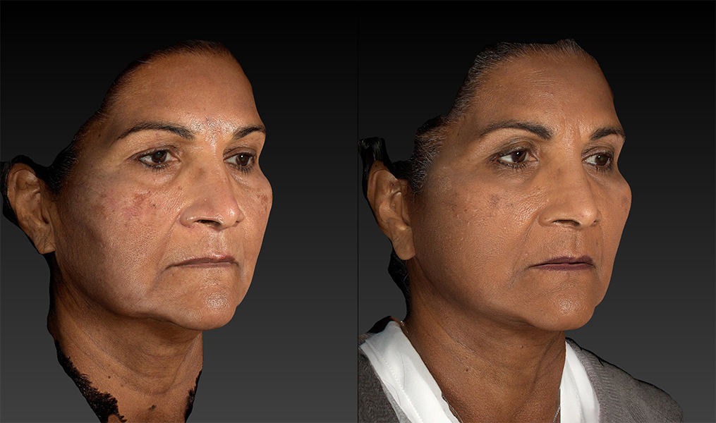 before and after facelift | mid-facelift right angle view case 3046