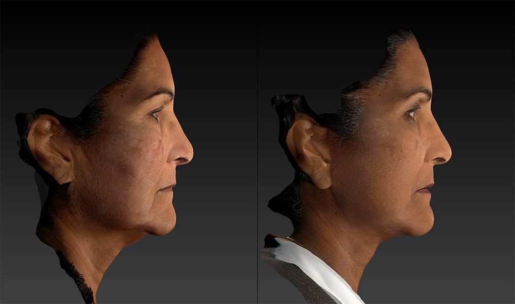 before and after facelift | mid-facelift right side view case 3046