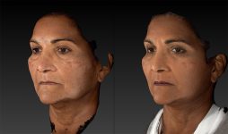 before and after facelift | mid-facelift left angle view case 3046
