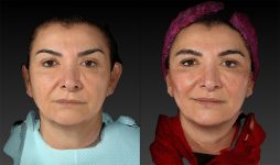 before and after facelift | mid-facelift front view case 2993