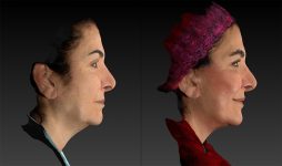 before and after facelift | mid-facelift right side view case 2993