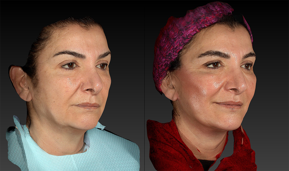 before and after facelift | mid-facelift right angle view case 2993