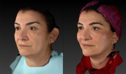 before and after facelift | mid-facelift left angle view case 2993