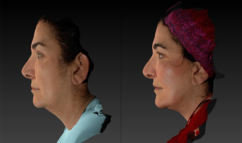 before and after facelift | mid-facelift left side view case 2993