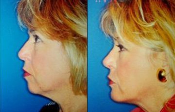 before and after facial implants female patient left side view case 2582
