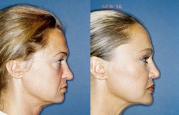 before and after facial implants female patient right side view case 2584