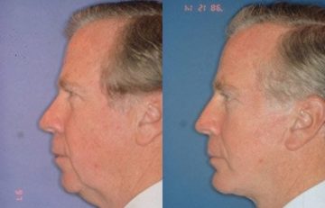before and after facial implants male patient left side view case 2588