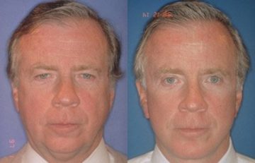 before and after facial implants male patient front view case 2588