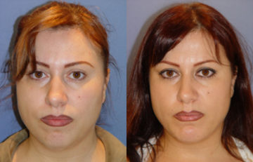 before and after facial implants front view case 2597