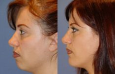 before and after facial implants left side view case 2597