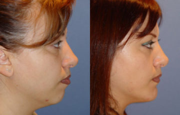 before and after facial implants right side view case 2597