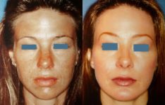 before and after facial implants female patient front view case 2602