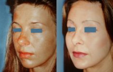 before and after facial implants female patient left angle view case 2602
