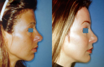 before and after facial implants female patient right side view case 2602