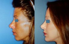 before and after facial implants female patient left side view case 2602