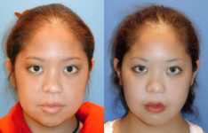 before and after female patient front view case 2613