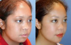 before and after facial implants female patient right angle view case 2613