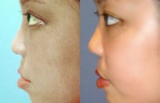 before and after facial implants female patient left side view case 2613