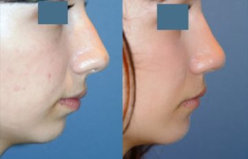 before and after facial implants right side view case 2619