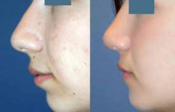 before and after facial implants left side view case 2619