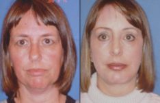 before and after facial implants female patient front view case 2631