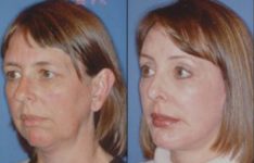 before and after facial implants female patient left angle view case 2631