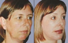 before and after facial implants female patient right angle view case 2631